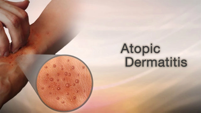 VTAMA Cream: FDA Approves New Atopic Dermatitis Treatment