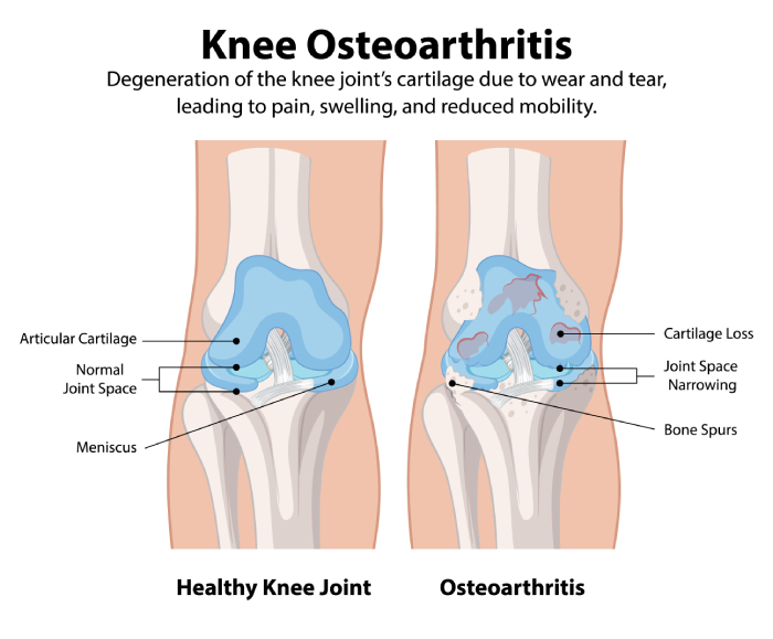 Un estudio demuestra que la colchicina no mejora los síntomas de la osteoartritis de rodilla - Featured Image