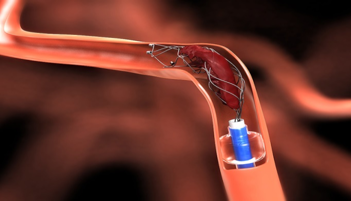 EVT for Large-Core Ischemic Strokes: A Paradigm Shift in Treatment - Featured Image