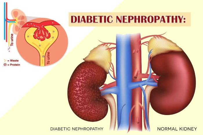 Glucosyl Hesperidin: A Promising Shield Against Diabetic Nephropathy - Featured Image