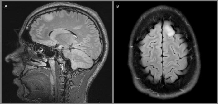 Groundbreaking Companion Diagnostic for Pediatric Brain Tumor Treatment - Featured Image