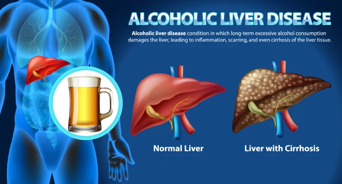 Combinación de niacina y B. animalis F1-7: un tratamiento prometedor para la enfermedad del hígado graso alcohólico - Featured Image