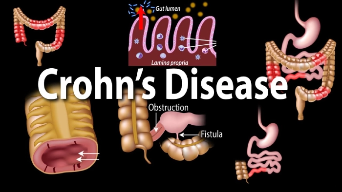 Omvoh: A Breakthrough in Crohn’s Disease Treatment - Featured Image