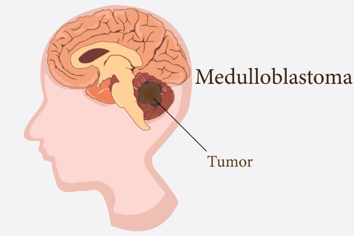 Potassium Channel Gene KCNB2: A New Target for Medulloblastoma Treatment - Featured Image