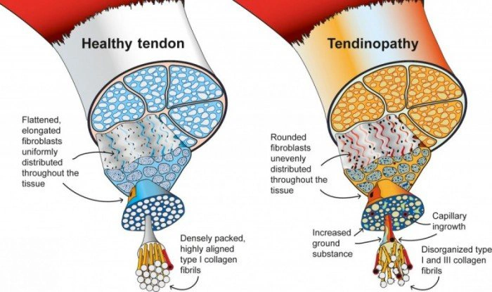 Tenex 2.ª generación: un gran avance en el tratamiento de las tendinopatías - Featured Image