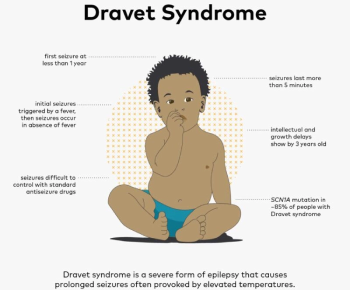 Zorevunersen: un gran avance en el tratamiento del síndrome de Dravet - Featured Image