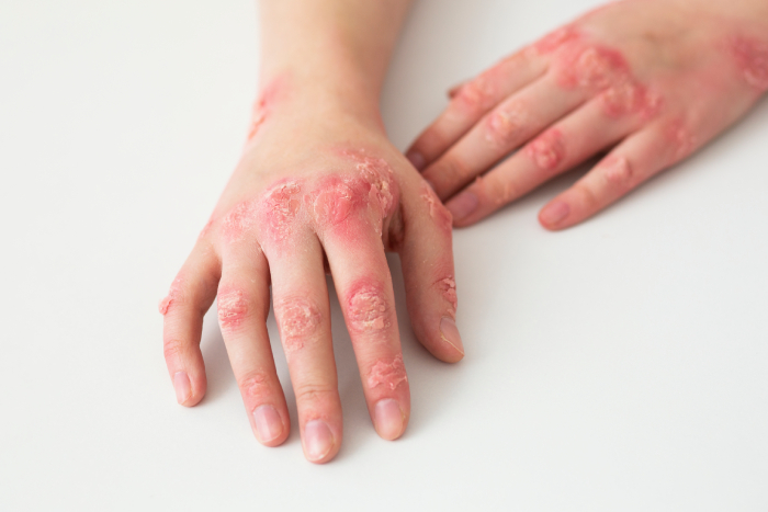 Un estudio muestra que el riesgo de eczema está vinculado a la contaminación del aire - Featured Image