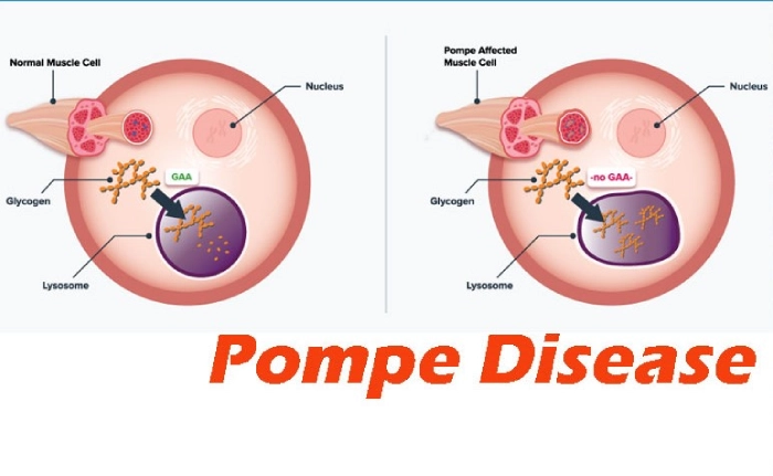 ABX1100: A Breakthrough in Late-Onset Pompe Disease Treatment - Featured Image