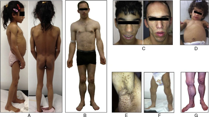 Genetic Medicine Breakthrough: ENTLEP001 and the Future of CGL Treatment  - Illustrations 1 - Genetic Medicine Breakthrough_