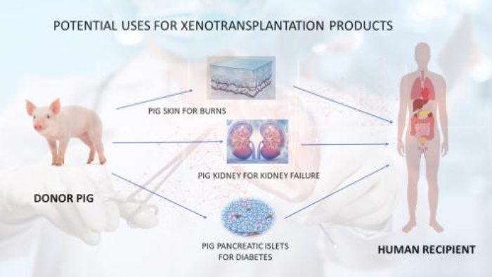 Xenotransplantation: A Revolutionary Step in Kidney Disease Treatment - Featured Image